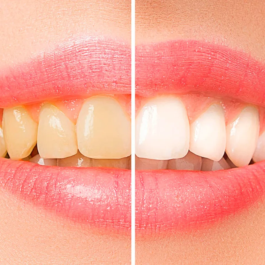 Blanqueamiento Dental Profesional en MAS Healthcare