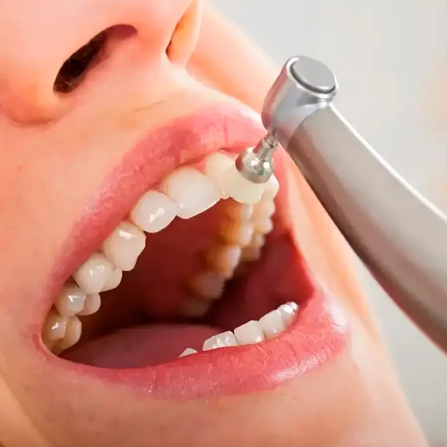 Limpieza dental profesional con ultrasonido en MAS Healthcare